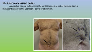 10. Sister mary joseph node:-
A palpable nodule bulging into the umbilicus as a result of metastasis of a
malignant cancer in the Stomach , pelvis or abdomen.
 