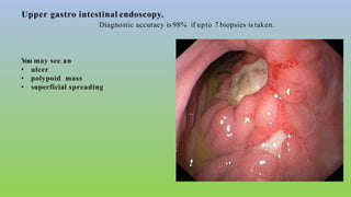 Upper gastro intestinal endoscopy.
Diagnostic accuracy is 98% if upto 7 biopsies is taken.
You may see an
• ulcer
• polypoid mass
• superficial spreading
 