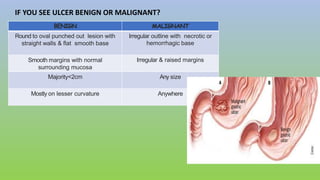 IF YOU SEE ULCER BENIGN OR MALIGNANT?
BENIGN MALIGNANT
Round to oval punched out lesion with
straight walls & flat smooth base
Irregular outline with necrotic or
hemorrhagic base
Smooth margins with normal
surrounding mucosa
Irregular & raised margins
Majority<2cm Any size
Mostly on lesser curvature Anywhere
 