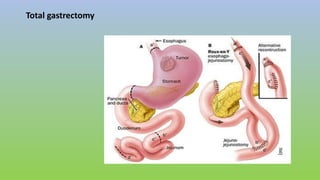 Total gastrectomy
 