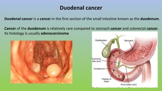 Duodenal cancer
Duodenal cancer is a cancer in the first section of the small intestine known as the duodenum.
Cancer of the duodenum is relatively rare compared to stomach cancer and colorectal cancer.
Its histology is usually adenocarcinoma
 