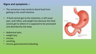 Signs and symptoms :-
• The cancerous mass tends to block food from
getting to the small intestine.
• If food cannot get to the intestines, it will cause
pain, acid reflux, and weight loss because the food
cannot get to where it is supposed to be processed
and absorbed by the body.
• abdominal pain,
• weight loss,
• nausea,
• vomiting,
• chronic gastrointestinal bleeding
 