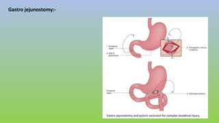 Gastro jejunostomy:-
 