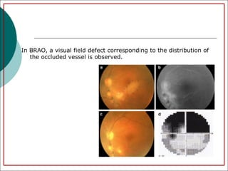 5_sudden_loss_of_vision_disorders.pdf