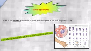 Is one of the congenital anomalies in which delayed eruption of the teeth frequently occurs.
Down Syndrome
Any delay of teeth could ultimately lead to ectopic eruption.
 