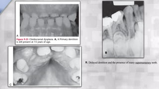 B, Delayed dentition and the presence of many supernumerary teeth.
B
 