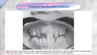 Congenital Hypothyroidism (Cretinism)
 