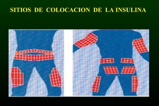 SITIOS DE COLOCACION DE LA INSULINA
 
