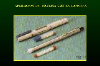APLICACION DE INSULINA CON LA LAPICERA
 