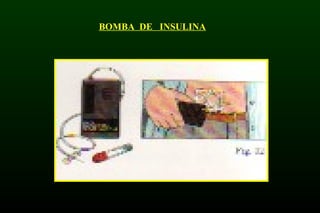 BOMBA DE INSULINA
 
