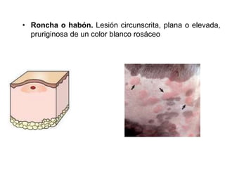 • Roncha o habón. Lesión circunscrita, plana o elevada, 
pruriginosa de un color blanco rosáceo 
 