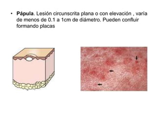 • Pápula. Lesión circunscrita plana o con elevación , varía 
de menos de 0.1 a 1cm de diámetro. Pueden confluir 
formando placas 
 