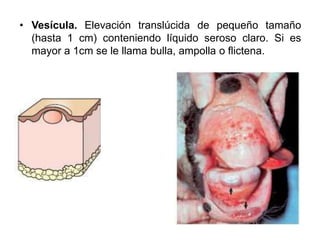 • Vesícula. Elevación translúcida de pequeño tamaño 
(hasta 1 cm) conteniendo líquido seroso claro. Si es 
mayor a 1cm se le llama bulla, ampolla o flictena. 
 