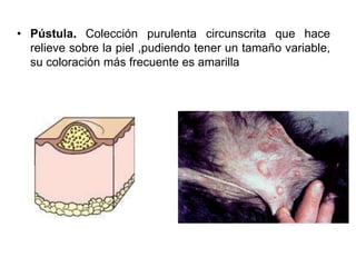 • Pústula. Colección purulenta circunscrita que hace 
relieve sobre la piel ,pudiendo tener un tamaño variable, 
su coloración más frecuente es amarilla 
 