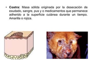 • Costra: Masa sólida originada por la desecación de 
exudado, sangre, pus y o medicamentos que permanece 
adherido a la superficie cutánea durante un tiempo. 
Amarilla o rojiza. 
 