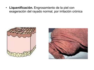 • Liquenificación. Engrosamiento de la piel con 
exageración del rayado normal, por irritación crónica 
 