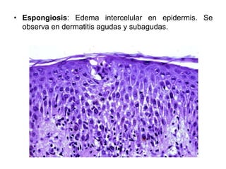• Espongiosis: Edema intercelular en epidermis. Se 
observa en dermatitis agudas y subagudas. 
 