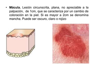 • Mácula. Lesión circunscrita, plana, no apreciable a la 
palpación, de 1cm, que se caracteriza por un cambio de 
coloración en la piel. Si es mayor a 2cm se denomina 
mancha. Puede ser oscuro, claro o rojizo 
 