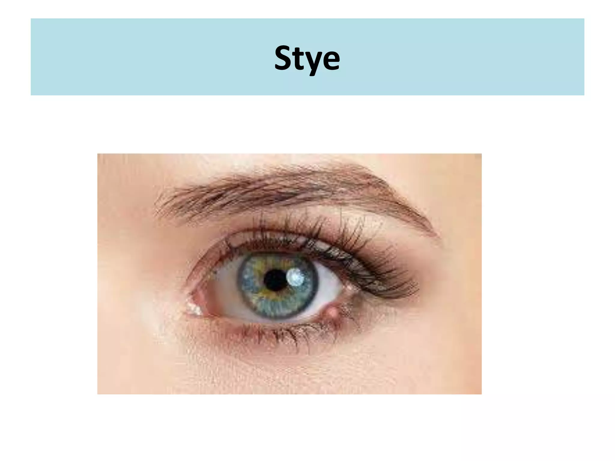 Stye
 