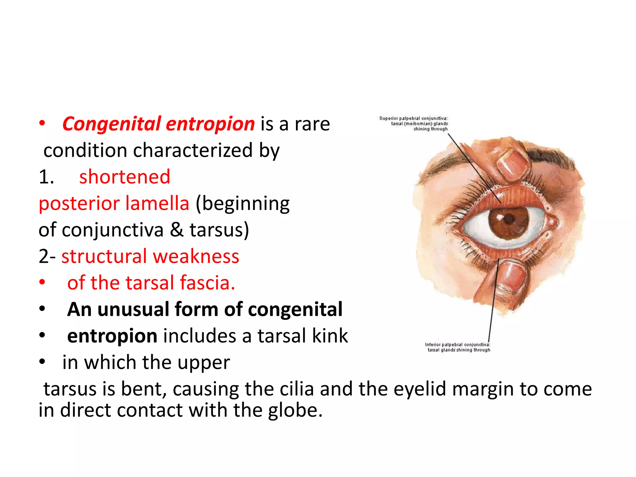 • Congenital entropion is a rare
condition characterized by
1. shortened
posterior lamella (beginning
of conjunctiva & tarsus)
2- structural weakness
• of the tarsal fascia.
• An unusual form of congenital
• entropion includes a tarsal kink
• in which the upper
tarsus is bent, causing the cilia and the eyelid margin to come
in direct contact with the globe.
 