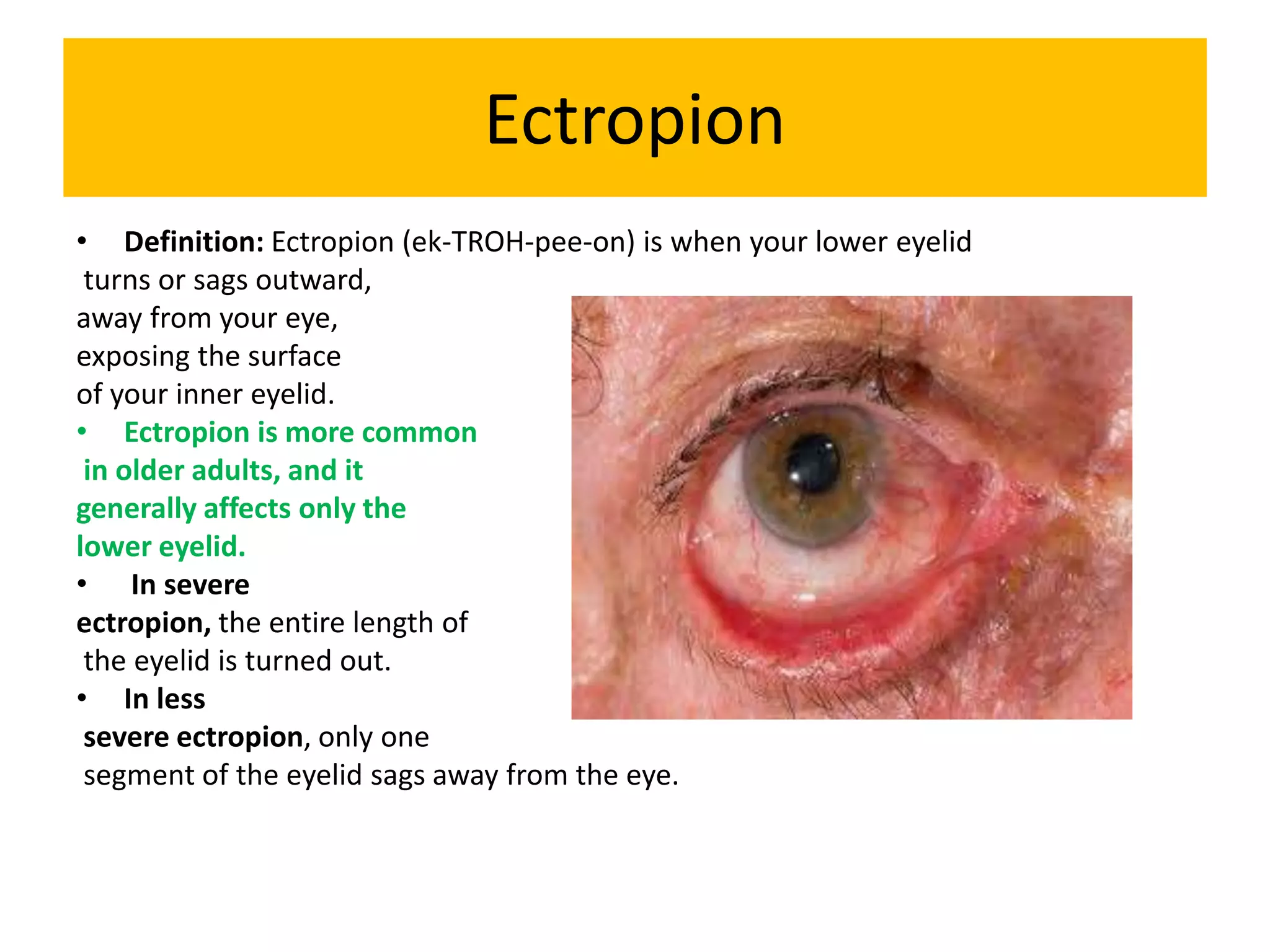 Ectropion
• Definition: Ectropion (ek-TROH-pee-on) is when your lower eyelid
turns or sags outward,
away from your eye,
exposing the surface
of your inner eyelid.
• Ectropion is more common
in older adults, and it
generally affects only the
lower eyelid.
• In severe
ectropion, the entire length of
the eyelid is turned out.
• In less
severe ectropion, only one
segment of the eyelid sags away from the eye.
 