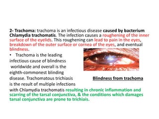 Trachom Ophthalmology | PPTX