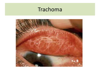 Trachoma
 
