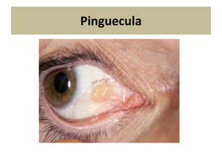 Pinguecula
 