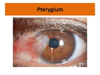 Pterygium
 
