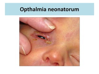 Opthalmia neonatorum
 