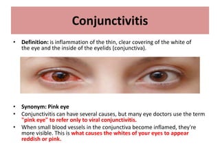 Conjunctivitis
• Definition: is inflammation of the thin, clear covering of the white of
the eye and the inside of the eyelids (conjunctiva).
• Synonym: Pink eye
• Conjunctivitis can have several causes, but many eye doctors use the term
"pink eye" to refer only to viral conjunctivitis.
• When small blood vessels in the conjunctiva become inflamed, they're
more visible. This is what causes the whites of your eyes to appear
reddish or pink.
 