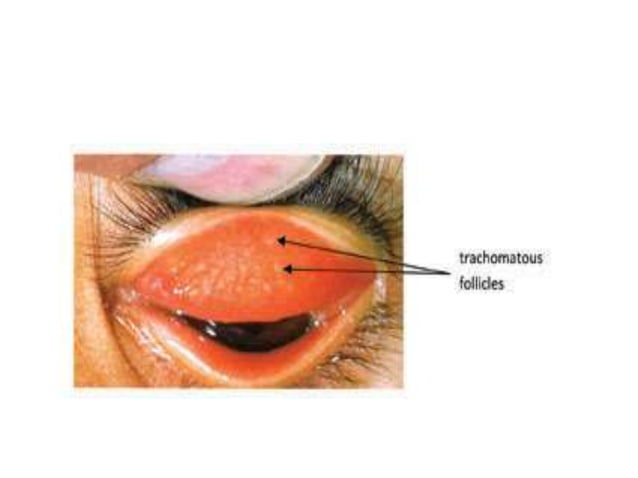 Diseases of conjunctiva | PPTX | Eye and Vision Conditions | Diseases ...