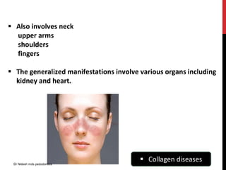  Also involves neck
upper arms
shoulders
fingers
 The generalized manifestations involve various organs including
kidney and heart.
 Collagen diseasesDr Nidesh mds pedodontics
 