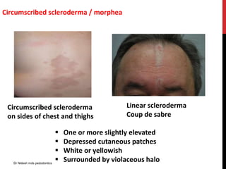 Circumscribed scleroderma / morphea
Circumscribed scleroderma
on sides of chest and thighs
Linear scleroderma
Coup de sabre
 One or more slightly elevated
 Depressed cutaneous patches
 White or yellowish
 Surrounded by violaceous haloDr Nidesh mds pedodontics
 
