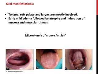 Oral manifestations:
 Tongue, soft palate and larynx are mostly involved.
 Early mild edema followed by atrophy and induration of
mucosa and muscular tissues
Microstomia , “mouse fascies”
Dr Nidesh mds pedodontics
 