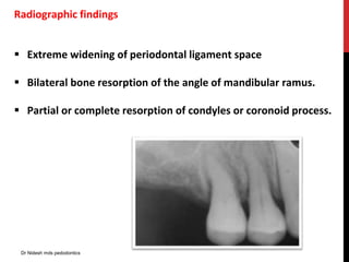 Radiographic findings
 Extreme widening of periodontal ligament space
 Bilateral bone resorption of the angle of mandibular ramus.
 Partial or complete resorption of condyles or coronoid process.
Dr Nidesh mds pedodontics
 