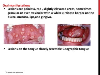 Oral manifestations
 Lesions are painless, red , slightly elevated areas, sometimes
granular or even vesicular with a white circinate border on the
buccal mucosa, lips,and gingiva.
 Lesions on the tongue closely resemble Geographic tongue
Dr Nidesh mds pedodontics
 