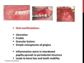  Oral manifestations:
 Ulcerative
 Friable
 Granular lesions
 Simple enlargments of gingiva
 Inflammation starts in interdental
papilla,spreads to periodontal structure
 Leads to bone loss and tooth mobility
Dr Nidesh mds pedodontics
 
