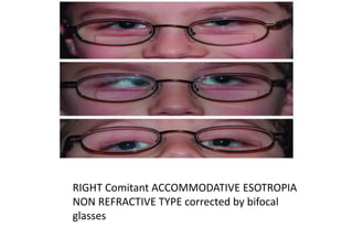 RIGHT Comitant ACCOMMODATIVE ESOTROPIA
NON REFRACTIVE TYPE corrected by bifocal
glasses
 