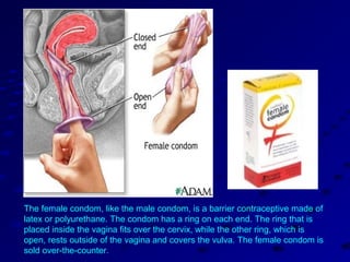 The female condom, like the male condom, is a barrier contraceptive made of
latex or polyurethane. The condom has a ring on each end. The ring that is
placed inside the vagina fits over the cervix, while the other ring, which is
open, rests outside of the vagina and covers the vulva. The female condom is
sold over-the-counter.
 