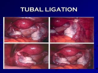 TUBAL LIGATIONTUBAL LIGATION
 