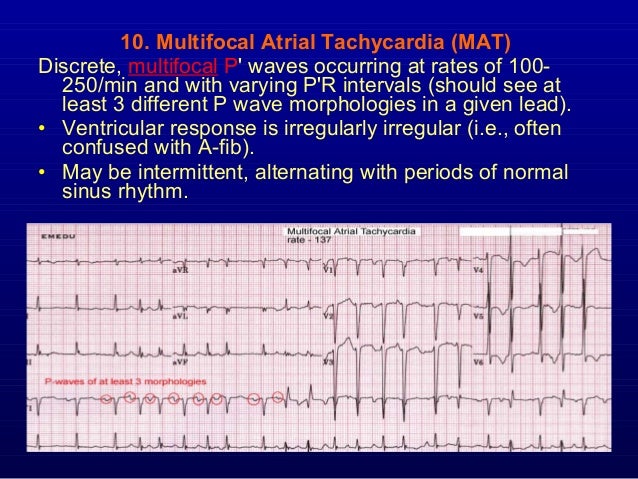 5th Part Ecg Basics Supraventricular Arrhythmias Dr Salah Mabrouk Kh