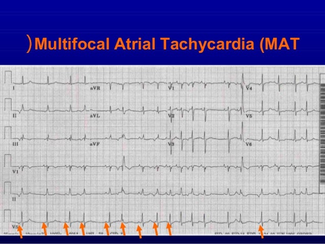 5th Part Ecg Basics Supraventricular Arrhythmias Dr Salah Mabrouk Kh