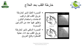 ‫خارطة القلب بعد العالج‬
‫• الصورة العليا تشير لخارطة‬
‫عروق القلب قبل تركيب‬
‫الدعامات واستخدام البالون‬
‫وتظهر فيها عدد من الشرايين‬
‫المسدودة‬
‫• الصورة السلفى تشير لخارطة‬
‫عروق القلب بعد اداء عملية‬
‫القسطرة وفتح العروق‬
‫,‪Prepared by Dr Nazeeh Sh Alothmany‬‬
‫‪http://nothmany.kau.edu.sa‬‬

 