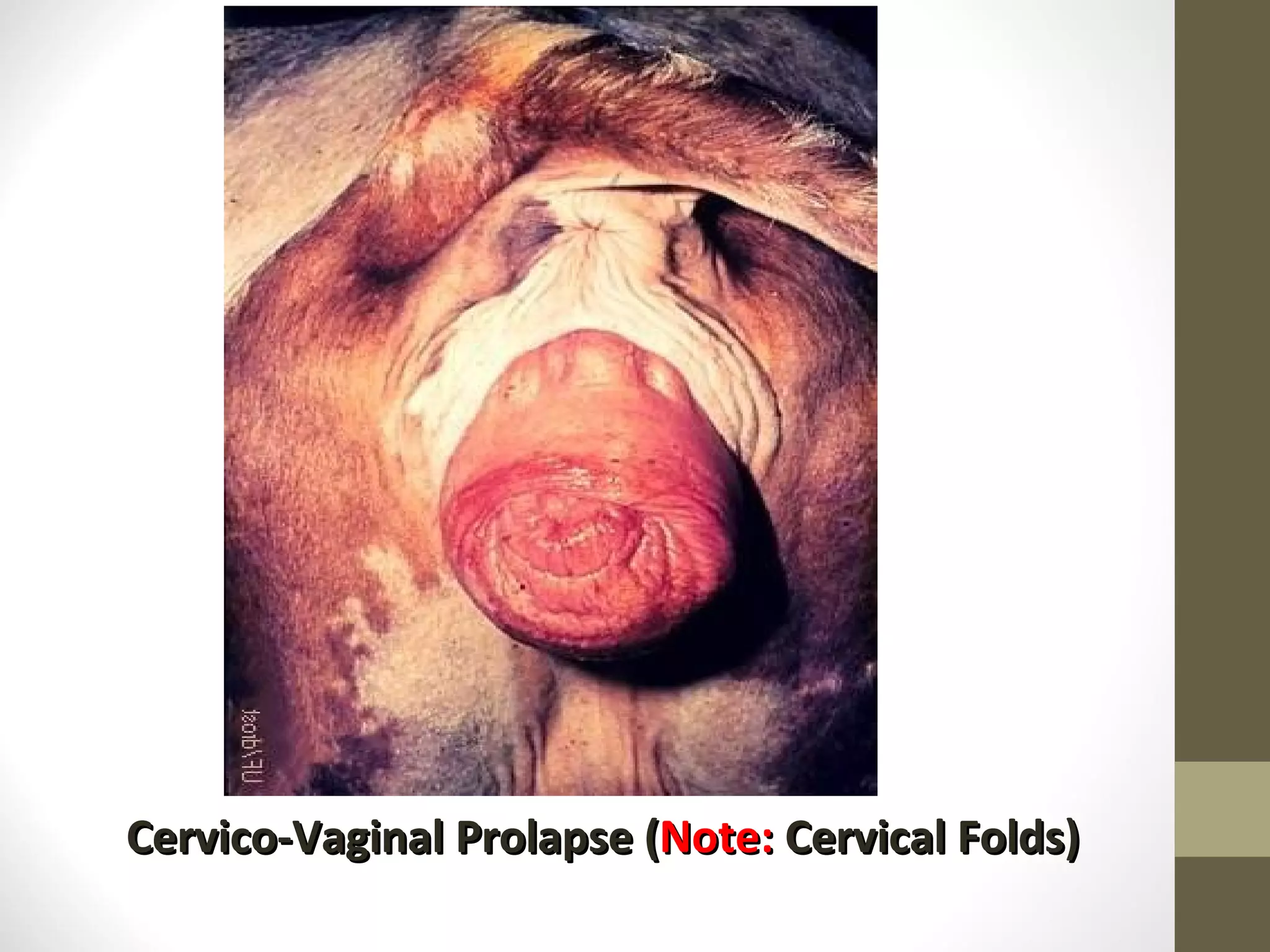 Cervico-Vaginal Prolapse ( Note: Cervical Folds)