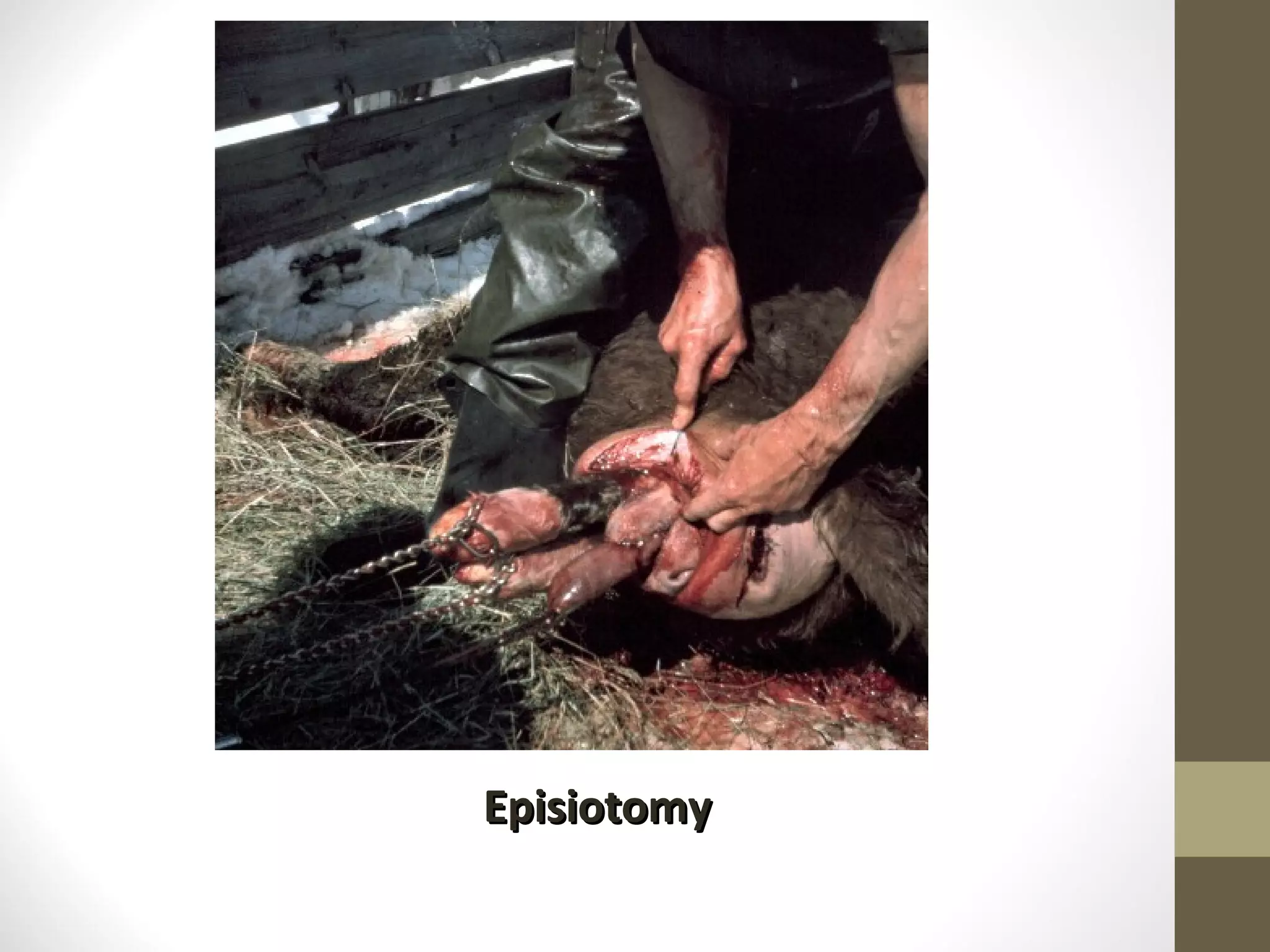 Episiotomy