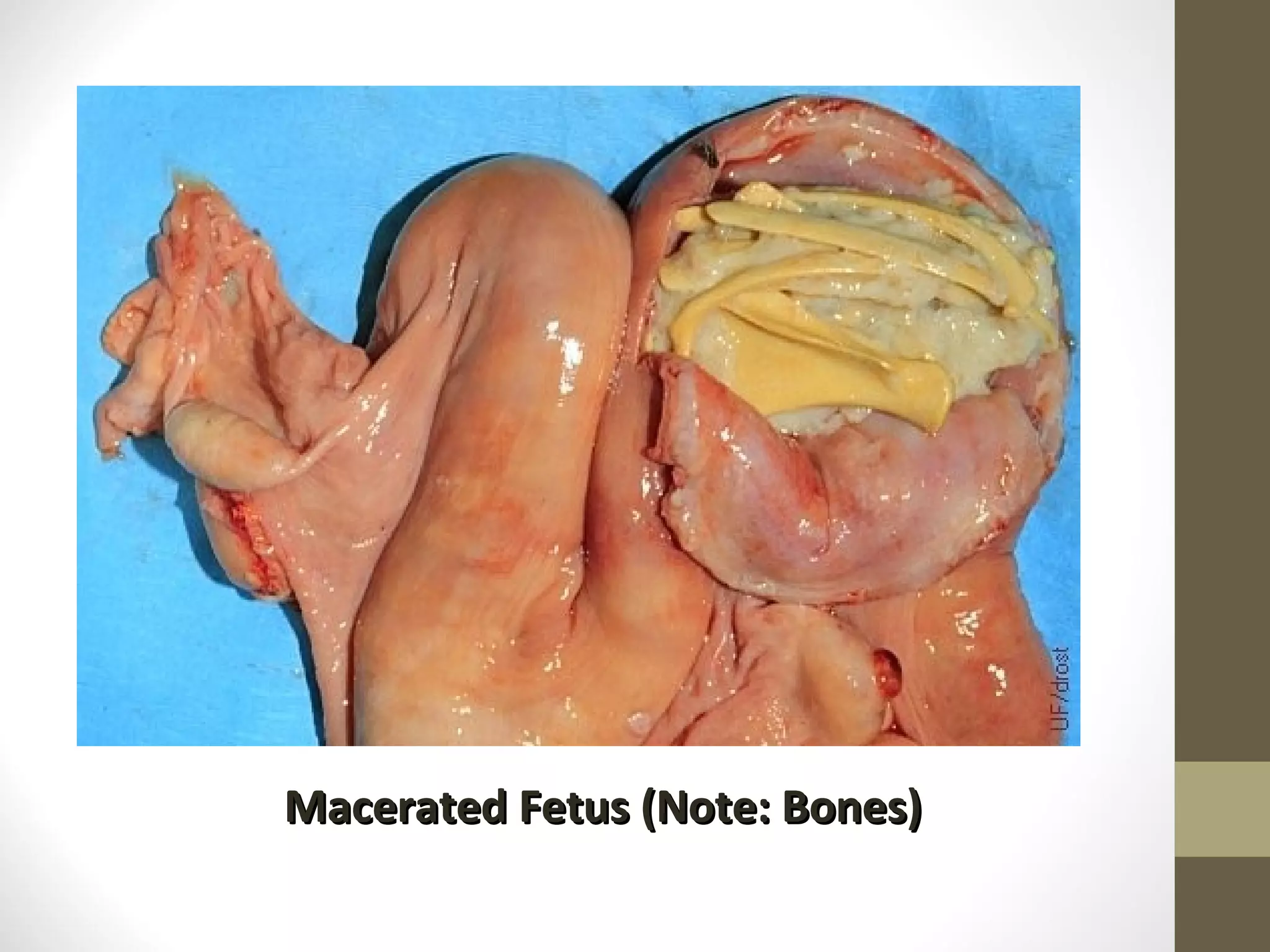 Macerated Fetus (Note: Bones)