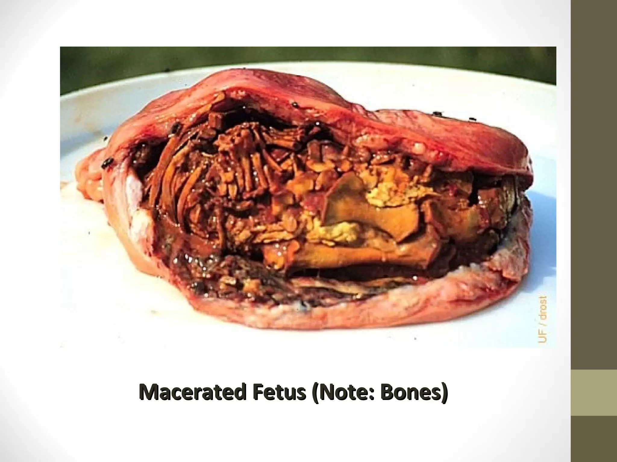 Macerated Fetus (Note: Bones)