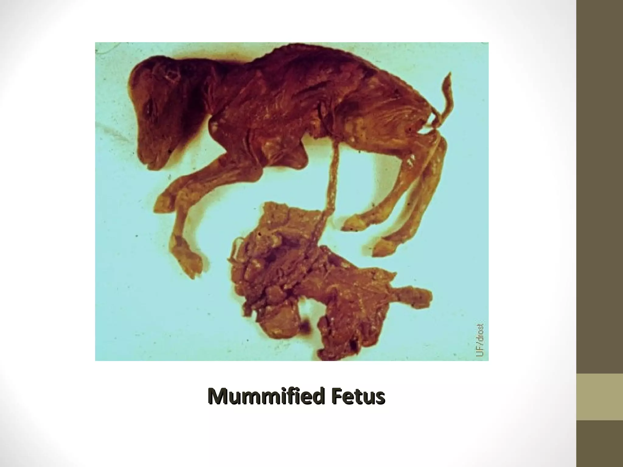 Mummified Fetus