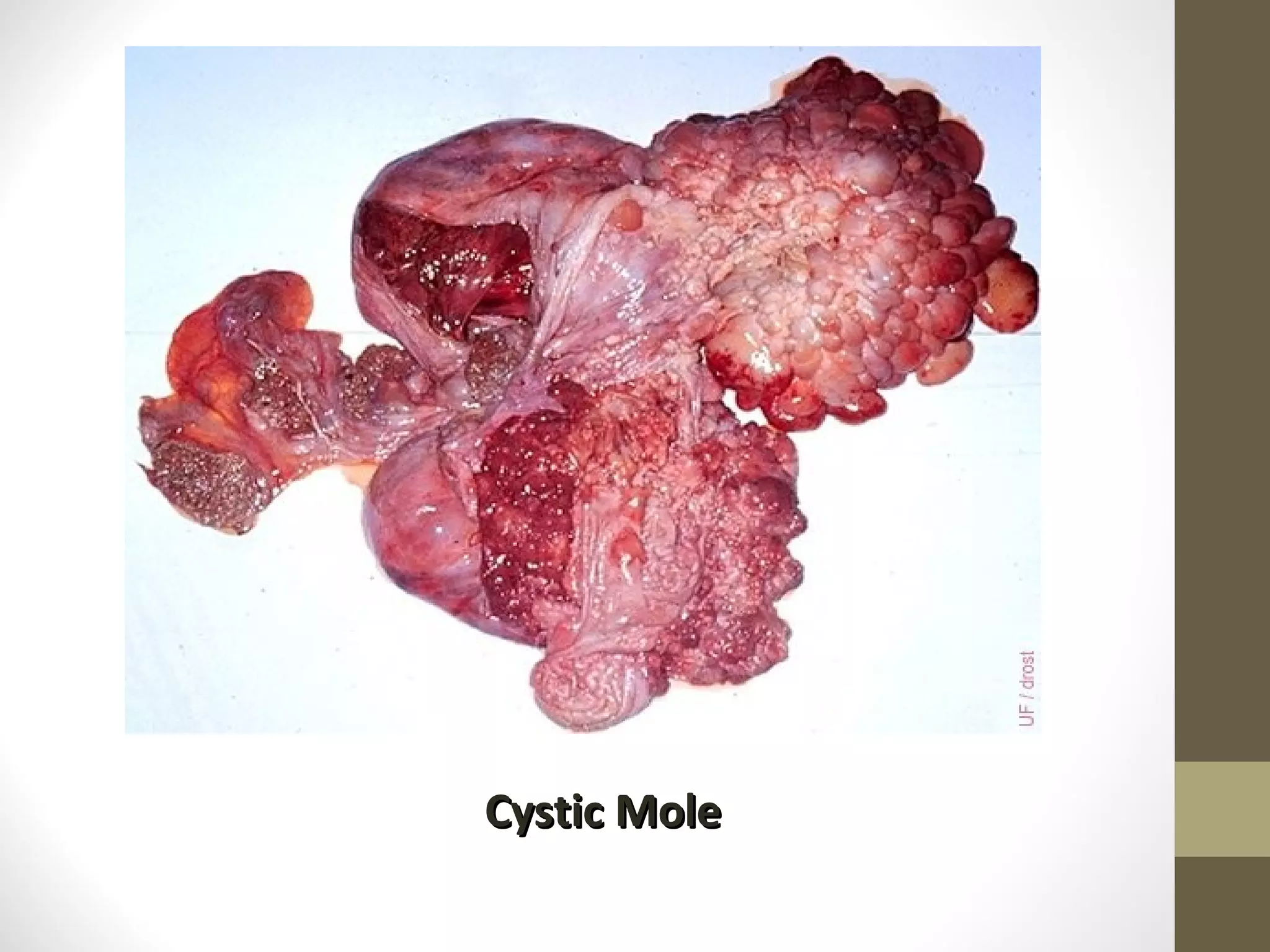 Cystic Mole